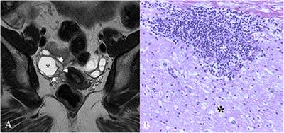 Case Report: Anti-N-Methyl-D-Aspartate Receptor Encephalitis Manifesting With an Isolated Psychiatric Episode and Normal Ancillary Tests
